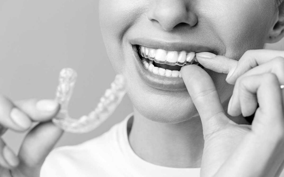 Invisalign vs. Traditional Braces: Which Orthodontic Treatment Is Right for Your North Idaho Lifestyle?